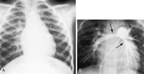 Pulmonary Stenosis With Interatrial Communication Thoracic Key