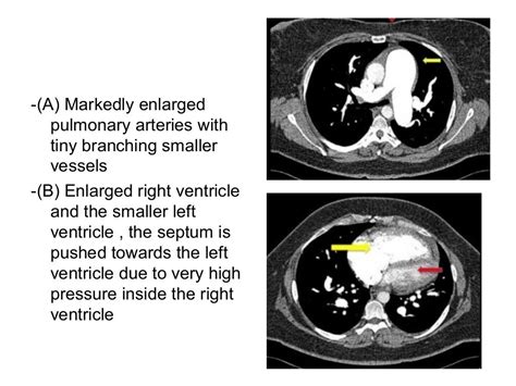 Diagnostic Imaging Of Pulmonary Vasculature