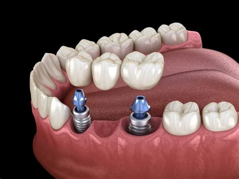 Dental Implant Supported Bridge Birmingham St Pauls Square Dental