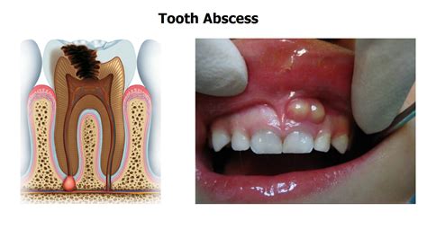 5 Stages Of Tooth Decay Dental Tooth Decay Abscess Tooth