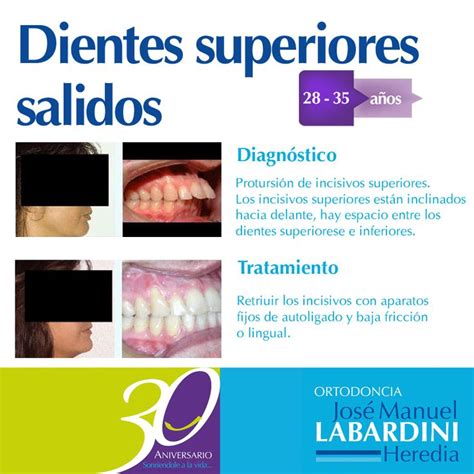 Dientes Superiores Salidos Ortodoncia Incisivos 35 Años
