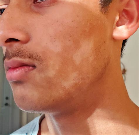 Skin Concerns Any Recommendation On These White Patches On My