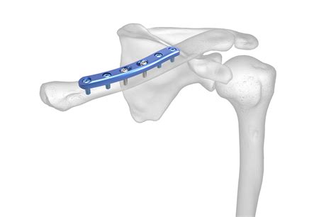 Clavicle Plating System Acumed