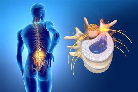 Treatment Options For Your Herniated Disc Franz Jones D O Pain