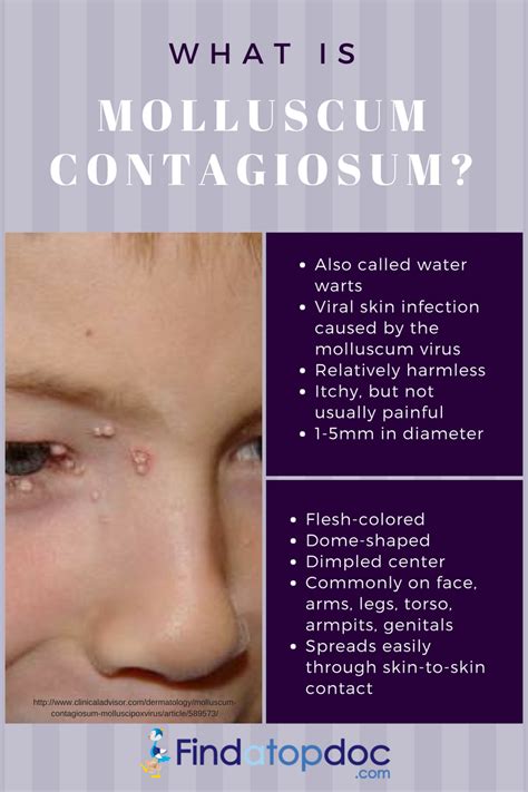 Molluscum Contagiosum Symptoms Causes Treatment And Life Cycle Images And Photos Finder