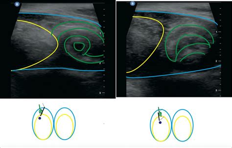 Ultrasonographic ‘whirlpool Sign In Testicular Torsion Bmj Case Reports