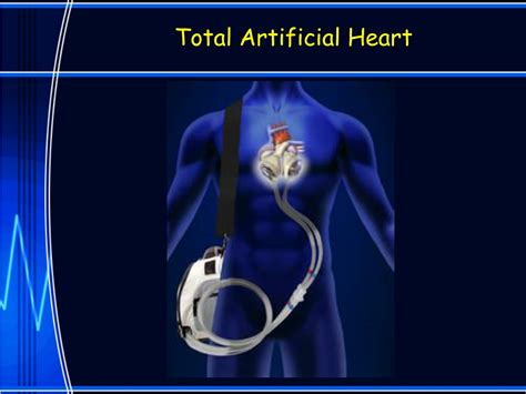 Ppt Mechanical Circulatory Support Devices Powerpoint Presentation
