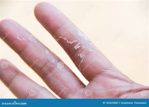 Asian Woman Palm Right With Flaky Peeling On The Ring Finger Hand Allergic To Dish Washing