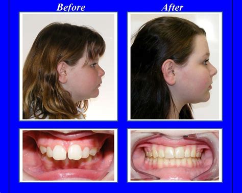 This Patients Overbite Was More Than 4 Times The Normal Overbite We Used Braces With A Combina