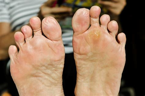 Calluses And Corns Foot And Ankle Wellness Centre