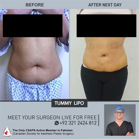 Liposuction Before And After Surgery Cosmetic Surgeon