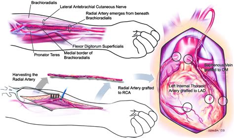 Should Radial Arteries Be Used Routinely For Coronary Artery Bypass