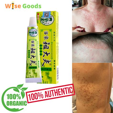 magic herbal cream ointment authentic zudaifu for body psoriasis dermatitis eczema pruritus