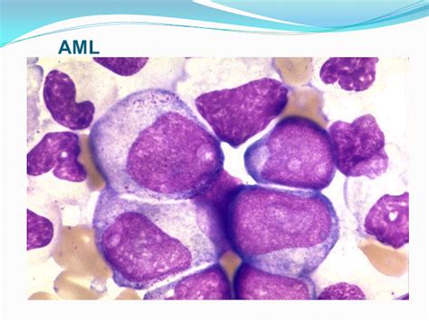 Leukemia Epidemiologi Patogenesis Leukemia Akut Artikesehatanmu