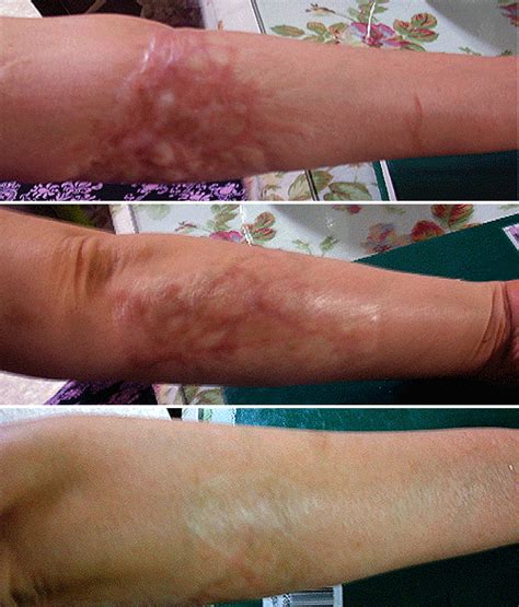How To Treat Burn Scars Heal Info