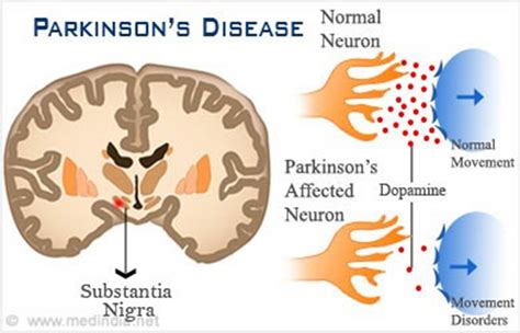 Overview Of Parkinsons And Healthy Person Neurons 18 Download