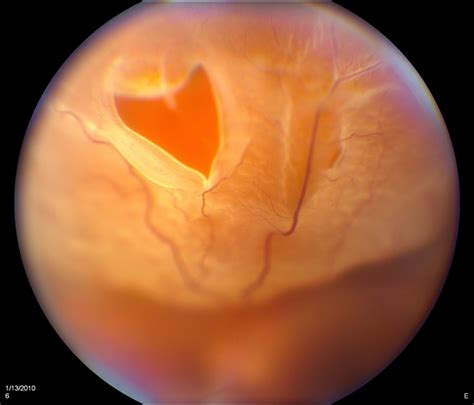 Horseshoe Retinal Tear Retina Image Bank