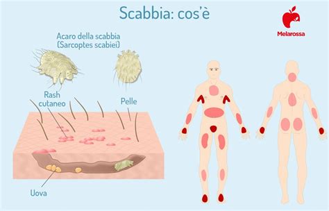 Scabbia Cosè Come Si Trasmette Sintomi Diagnosi Cure E Prevenzione