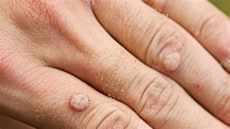 A Wart Can Affect Your Professional Life So Have Yours Removed MedSkin Clinic