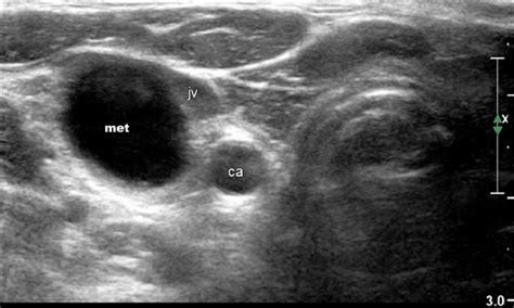 Ultrasound Image Of Enlarged Lymph Node In Level Iii Of The Right Neck
