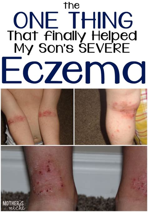 12 Best Images About Eczema On Pinterest Natural Moisturizer Organic