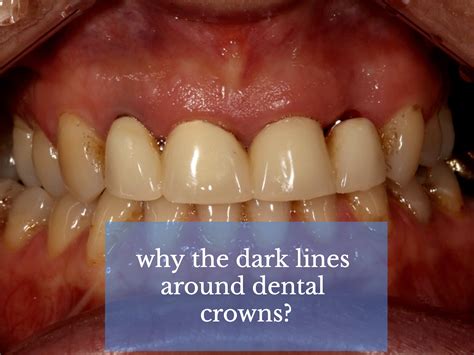 Black Lines On Teeth Teethwalls