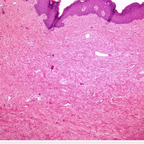 PDF Giant Ulcerated Fibroepithelial Stromal Polyp Of The Vulva A