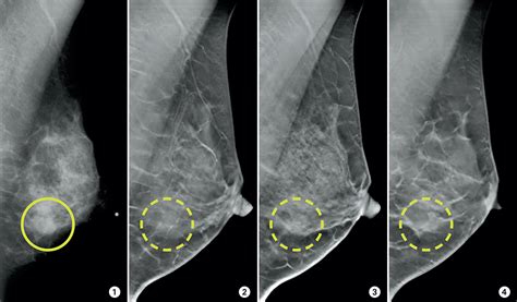 what does breast cancer look like on a mammogram