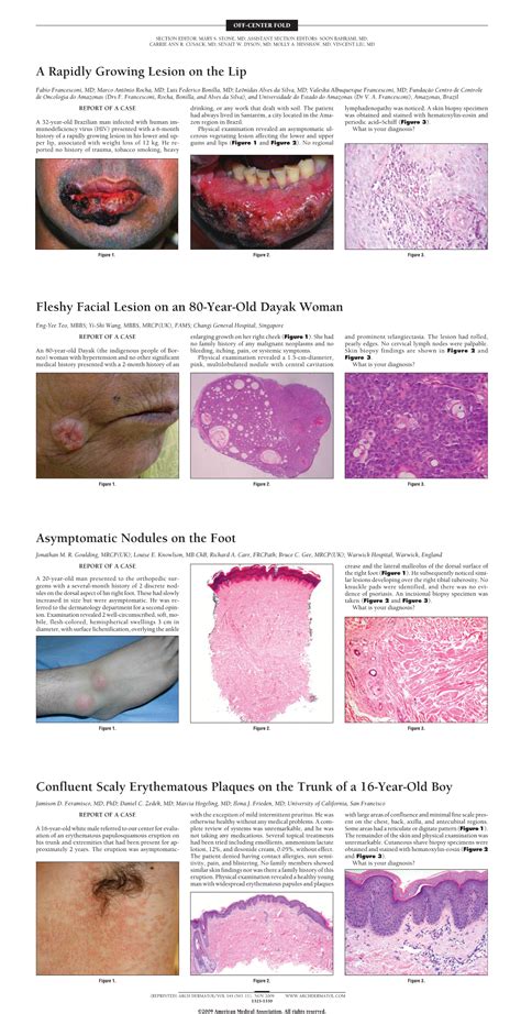 Confluent Scaly Erythematous Plaques On The Trunk Of A 16 Year Old Boy