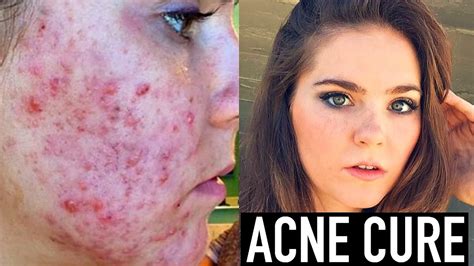 Curing Acne Acne Scar Treatment Youtube