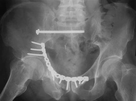 Reconstruction plate in a patient with ipsilateral right ...