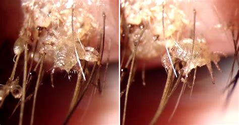 This Horrifying Close Up Video Of Eyelash Lice Will Give You Nightmares