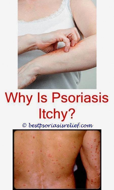 Pin On Uv Treatment For Psoriasis
