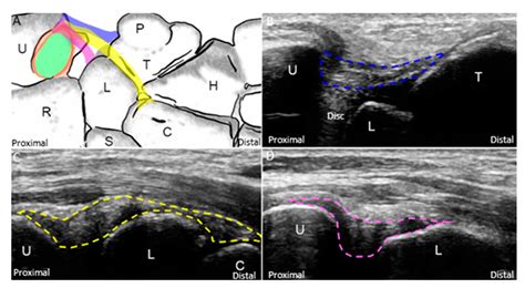 Jcm Free Full Text Ulnar Wrist Pain Revisited Ultrasound Diagnosis