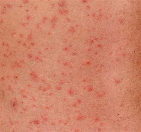 Scabies Rash Dark Skin