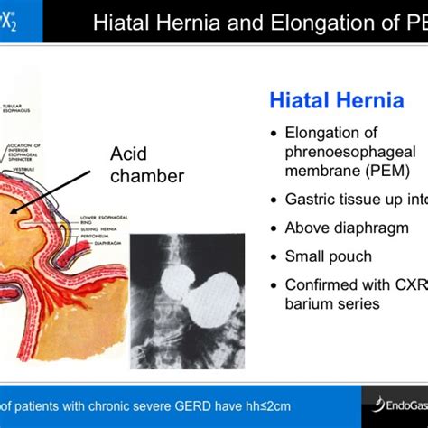 Hiatal Hernia Virginia Heartburn And Hernia Institute