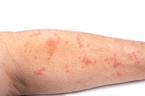 Rashes That Look Like Scabies Causes Symptoms And