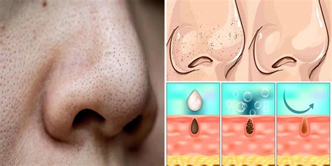 10 Ways To Help Clear Clogged Pores Stuff Lovely