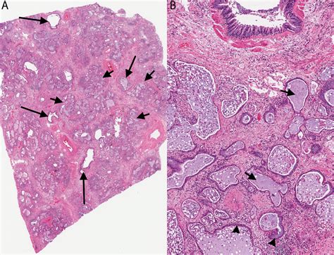 Usual Interstitial Pneumonia Uip A Clinically Significant Pathologic