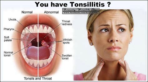 Gejala Penyakit Tonsilitis Homecare24