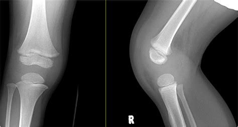 Radiographs Taken Of The Right Knee The Following Day Upon