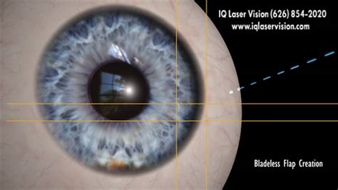 Z LASIK How Bladeless Eye Surgery Works YouTube