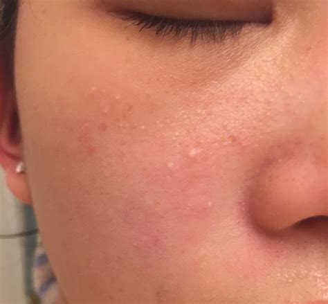 Skin Concern Ive Had These White Bumps For Years What Is Wrong With