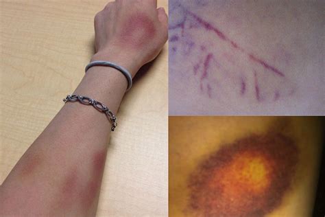 The Characteristics Of Bruises Godoy Medical Forensics