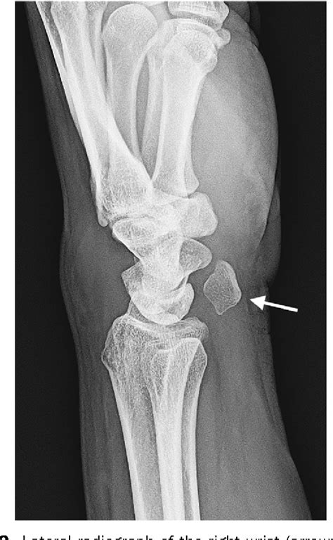 Figure 2 From Woman With Wrist Pain After Falling Isolated Pisiform