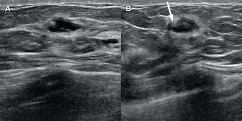 A 48 Year Old Female Presented With A Palpable Lump In The Left Breast