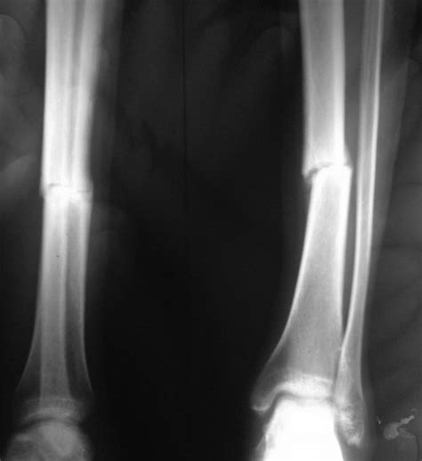 Radiographs Of Tibia Fibula Fracture Bone And Spine