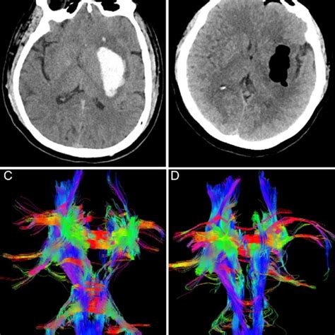 Illustrative Case Of Basal Ganglia Ich In A Previously Healthy