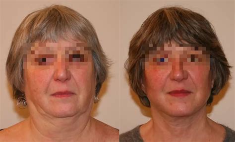 lifting visage et cou ou lifting frontal paris chirurgie