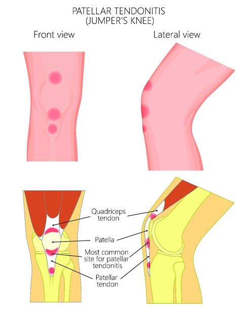 Knee tendons medical vector illustration scheme, anatomical diagram. Define Treated Floor Area | Review Home Decor